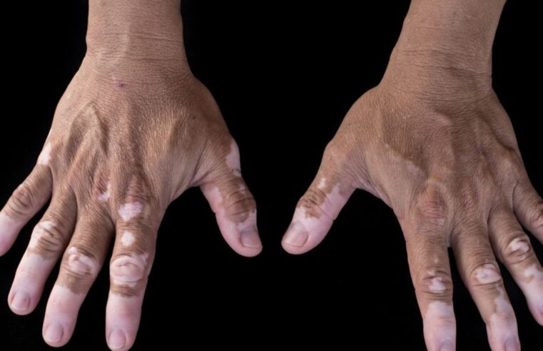 Al menos 5% de la población arequipeña padece vitiligo