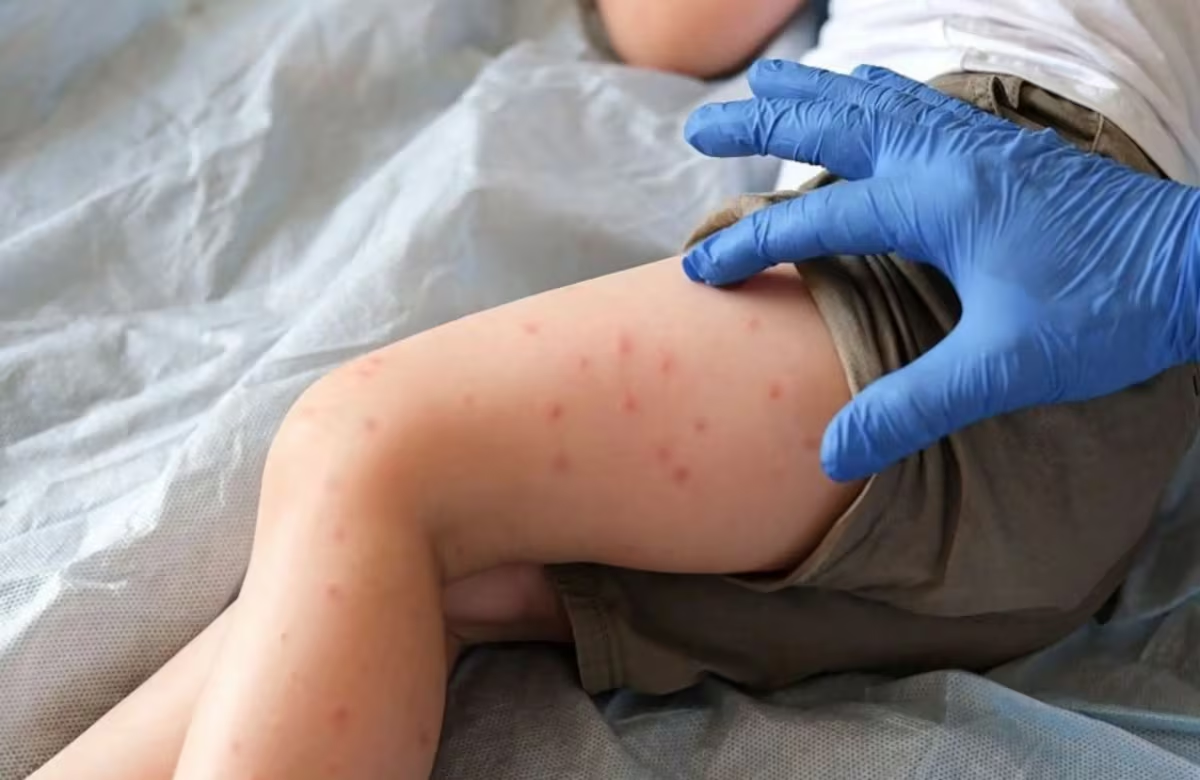 Arequipa registra 24 casos de sarampión