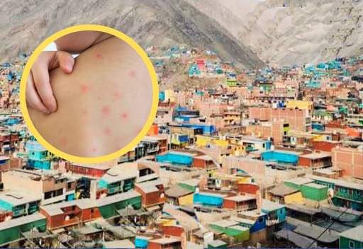 Dos niños sufren complicaciones por brote de sarampión en Camaná