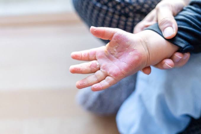 El 70% de las víctimas de quemaduras en Perú son niños y la cocina sigue siendo el principal peligro