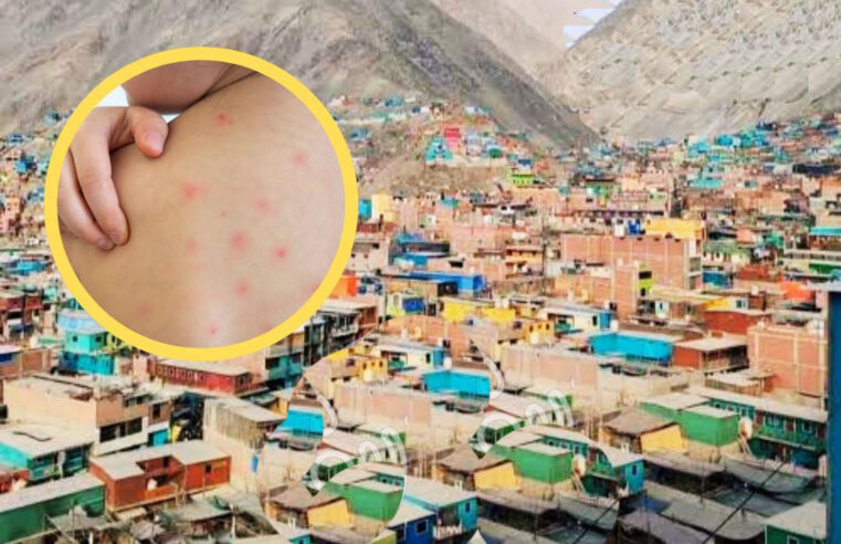 Secocha concentra más de la mitad de los casos de sarampión en Arequipa