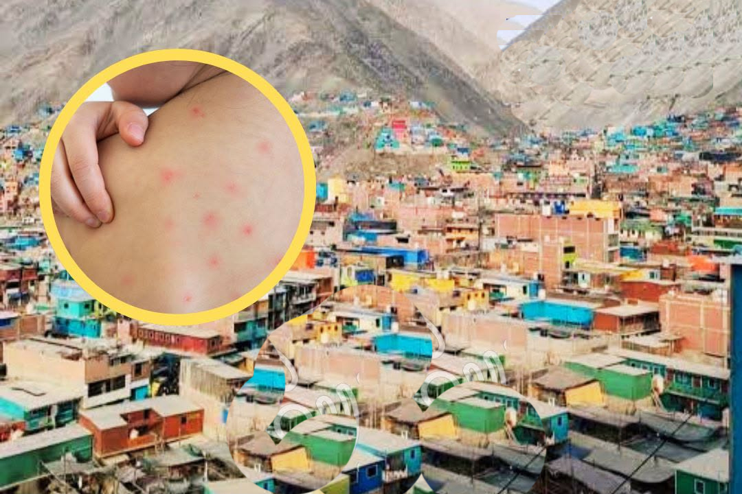 Secocha concentra más de la mitad de los casos de sarampión en Arequipa